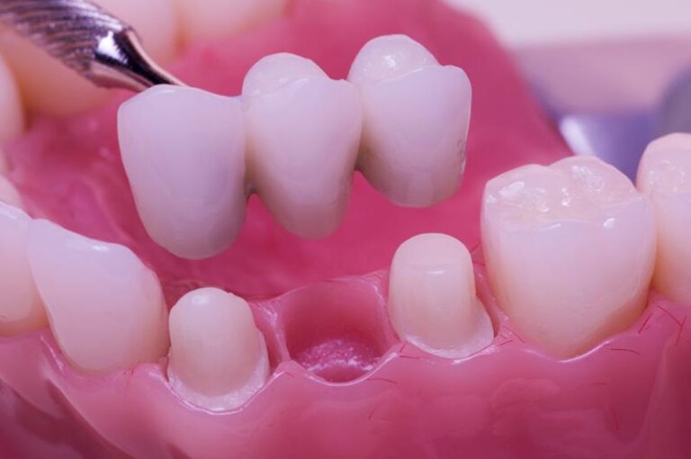 Dental bridge replacing a missing tooth between two natural-looking dental crowns