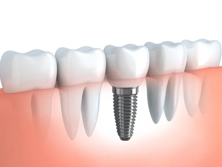 Dental implant replacing a missing tooth beside healthy gums and natural teeth