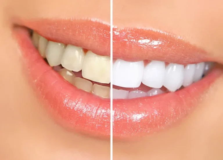 Before-and-after comparison showing results of professional teeth whitening in Winter Garden, FL