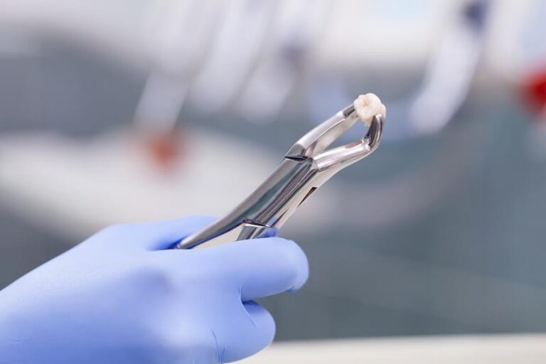 Extracted tooth held with dental forceps during a professional tooth removal procedure
