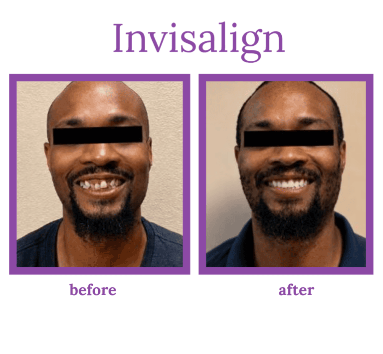 Side-by-side patient smile comparison before and after Invisalign treatment in Winter Garden, FL